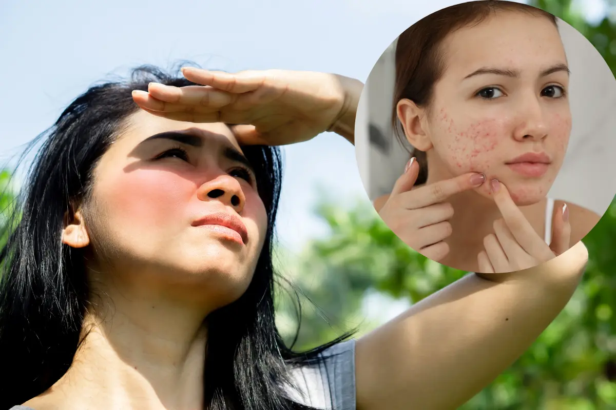 Summer acne